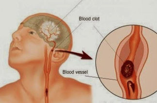 Tι κάνουμε σε ένα εγκεφαλικό; Παίρνει μόνο ένα λεπτό για να διαβάσετε αυτό