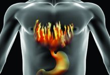 Γαστροοισοφαγική παλινδρόμηση: γιατί δεν πρέπει να αγνοούμε τα συμπτώματα