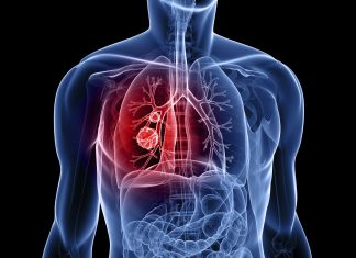 Σημαντική εναλλακτική θεραπεία για τους ασθενείς με καρκίνο του πνεύμονα